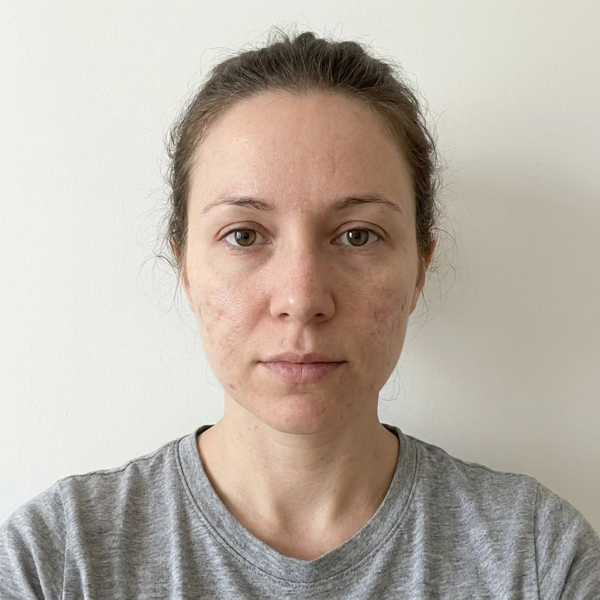 Vorher — sichtbare atrophe Narbenstruktur